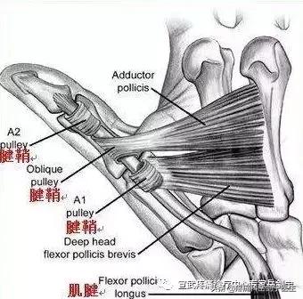 拇指伸不直，掰直了弯不回来还痛，因为啥？