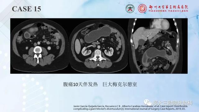 儿童腹部囊性病变诊断思路分析