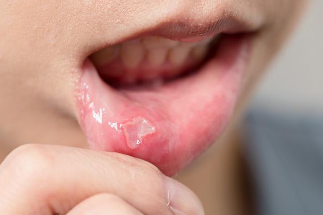 口舌生疮，反反复复，引发口腔溃疡的6个不良因素，尽量改掉它们