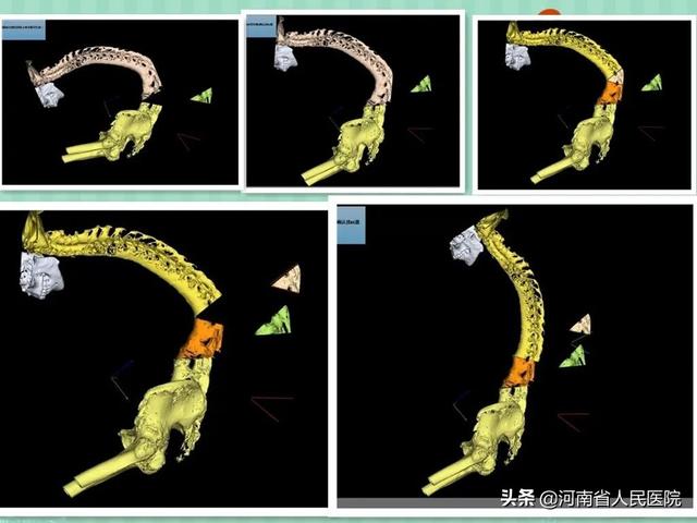 人工智能辅助，助力20年“折叠人”挺起脊梁