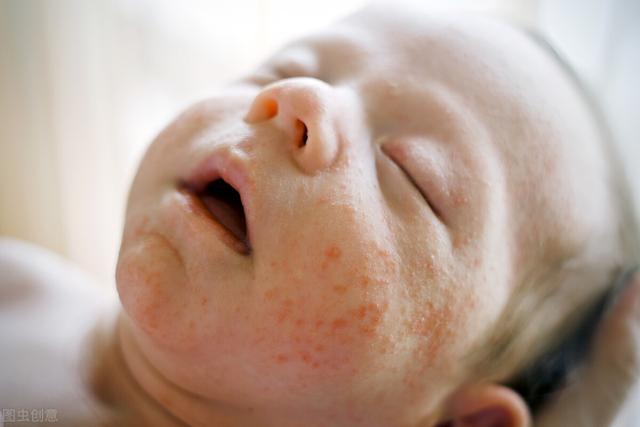 为什么宝宝容易患湿疹？主要是这5大因素在作祟