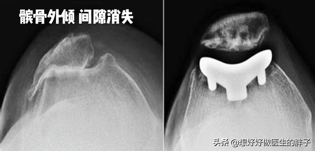 上下楼膝盖疼，平路没事，可能有髌骨软骨软化，医生教您一招自检