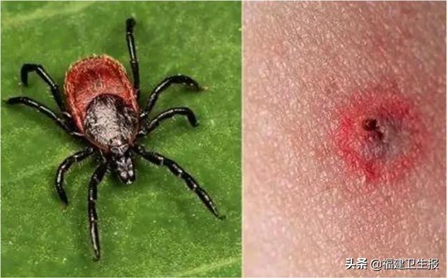 发热|福建疾控发布最新提醒：警惕这种急性传染病！夏天高发