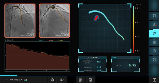 要不要放支架？这个最新检测方法很“硬正”省人医在江苏率先开展