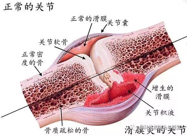 关节腔|骨科专家详解滑膜炎的诊治与预防归纳