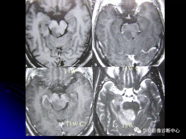「影像复习」脑干区常见病变影像表现