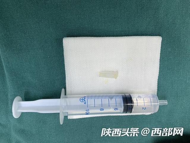 【西部网】西安一6岁女童咳嗽就会发出哨音 医生9小时急救取出“它”