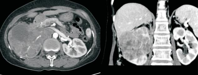 少见典型肾肿瘤一例，也容易误诊的病例