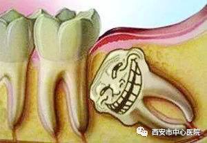 口腔科普系列——整天搞得我心神不定的智齿