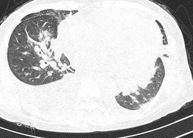 「典型」的肺水肿，为何用抗生素狂轰滥炸？