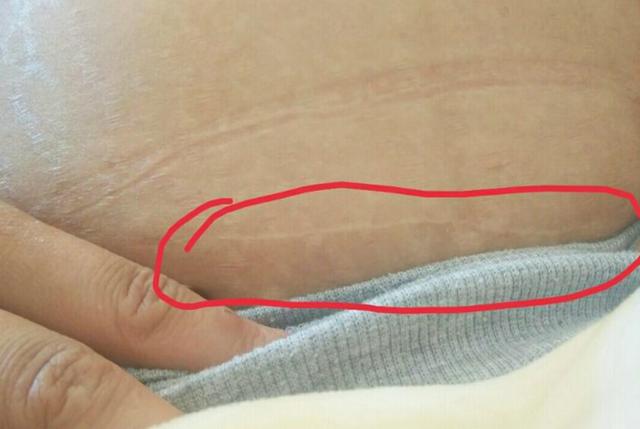 安全港|剖腹产顺便清除脂肪，产妇一顿神操作，生娃还能减肥？