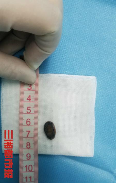 「你的育儿经」6岁女童“感冒”两年治不好,元凶竟是一粒西瓜籽