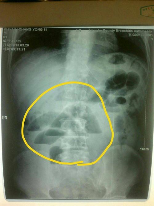 4个症状，提示肠梗阻，日常做好4点来预防