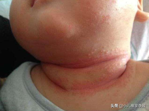 你的育儿经|小儿推拿李波：夏季宝宝淹脖子，发红又破皮怎么办？如何正确护理