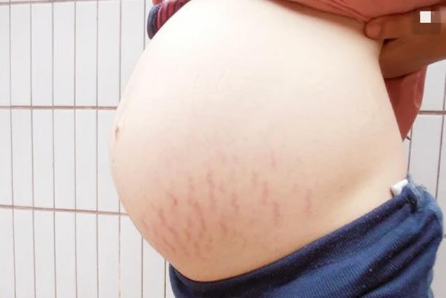 超级宝妈|辣妈生完四胞胎身材恢复迅速,晒出肚子却让人寒颤:做妈妈的代价