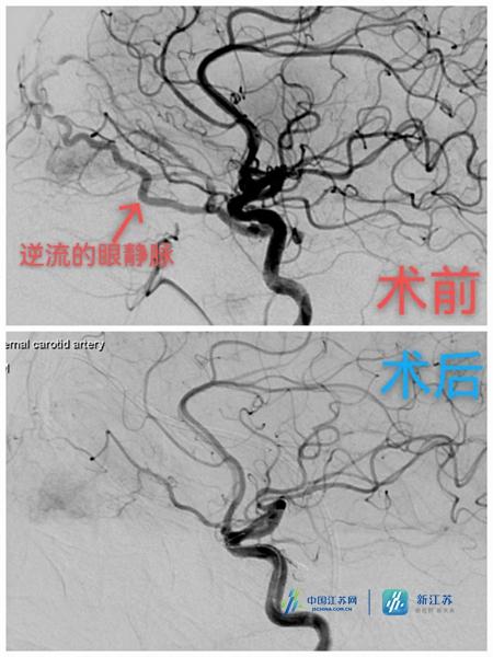 眼球|眼球充血肿胀是眼病吗？谨防颈动脉海绵窦瘘