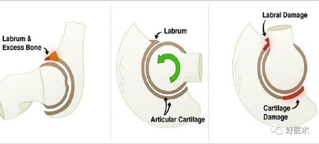 一文读懂髋关节撞击综合征