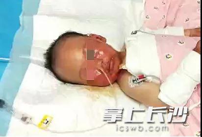 超级宝妈|一杯滚烫的开水让长沙1岁宝宝住进小儿重症监护室