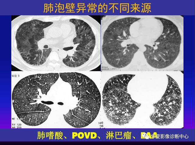 肺间质性疾病的解剖、病理、影像分析