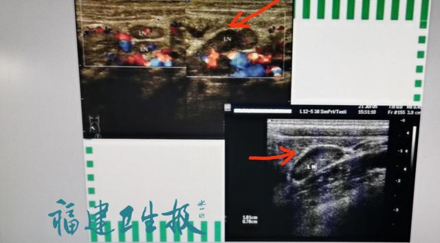 超级宝妈@福州7岁女童腹痛被送急诊！家长警惕！这种病春季高发