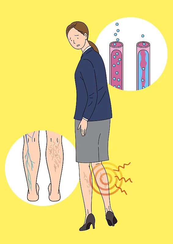 外科|静脉曲张会导致截肢？！这种常见病，千万别轻视→