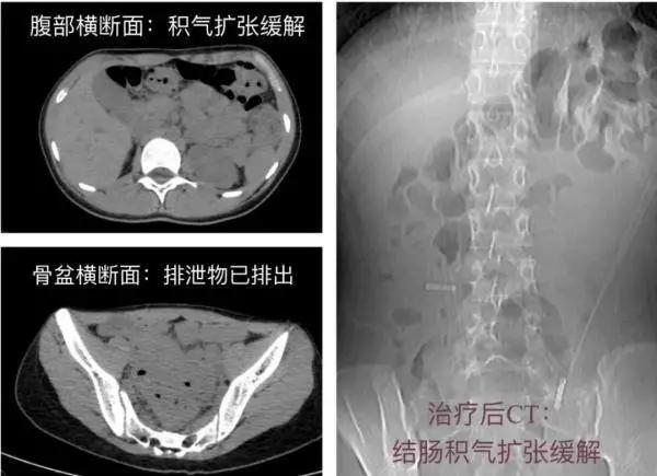 【可怕】妙龄女孩一晚解出8斤大便！多脏器“挤扁”？医生道出扎心真相！