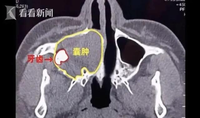 医生|男子右眼莫名流泪，一查竟是鼻腔长了牙