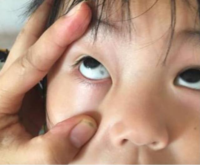 超级宝妈■孩子眼白部分有“黑点”，大多与3个原因有关，父母要小心