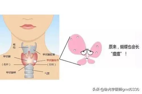 从中医角度谈甲状腺结节的产生。如何预防结节恶化？