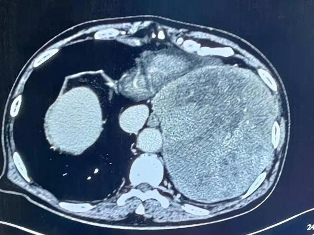 德州二院完成一例高难度手术，从患者胸膛抱出20公分巨大肿瘤