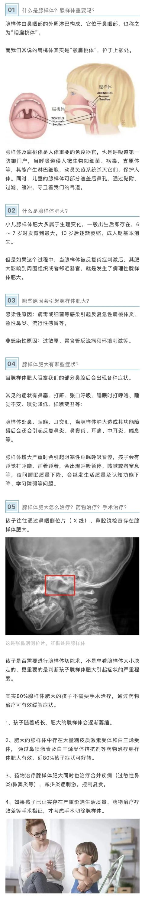 治疗|80%腺样体肥大的孩子不需要手术治疗