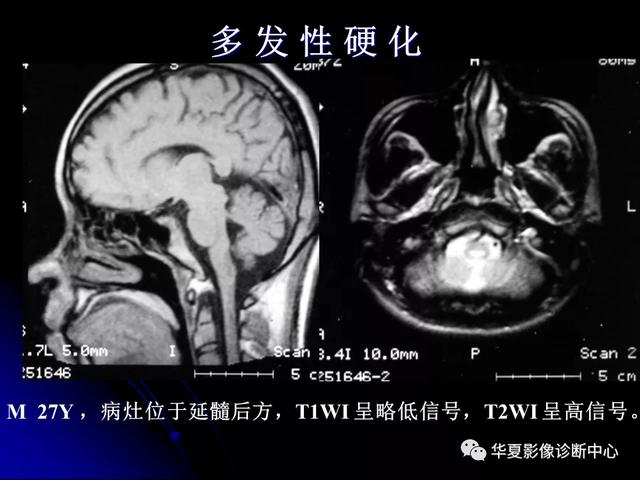 「影像复习」脑干区常见病变影像表现