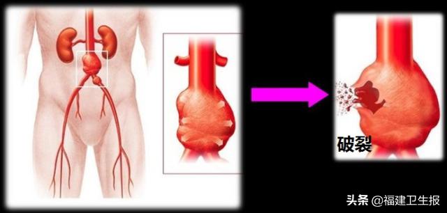 血管|肚子里长了个东西和心脏同时跳动，泉州老太查出体内有“血管炸弹”，全家吓坏了