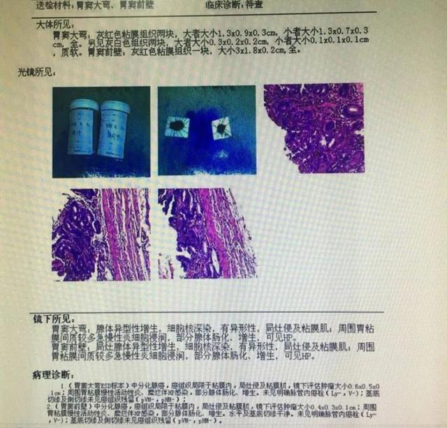 胃肠镜到底做不做？这3例早癌都没症状，内镜下根治除后患