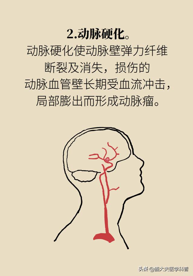 脑动脉瘤之一：脑动脉瘤是脑卒中吗？