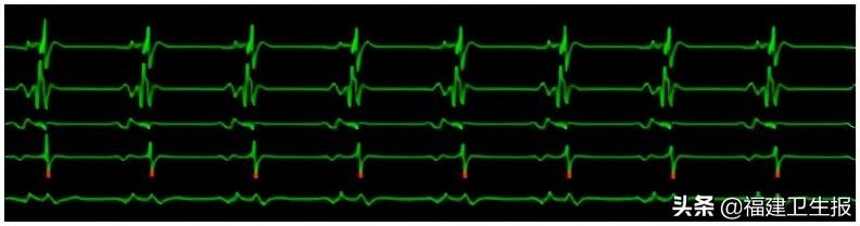 心脏|龙岩5岁女童心跳似打鼓，但一检查就恢复正常心跳！专家：这些异常状况家长需引起重视
