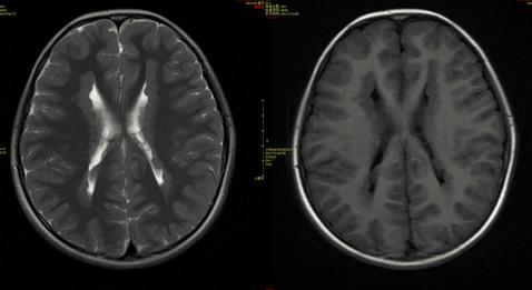 医影学堂丨八个病例带你看懂脑灰质异位的三种类型