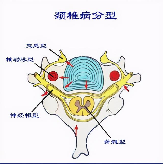 拔火罐可以治疗颈椎病吗？