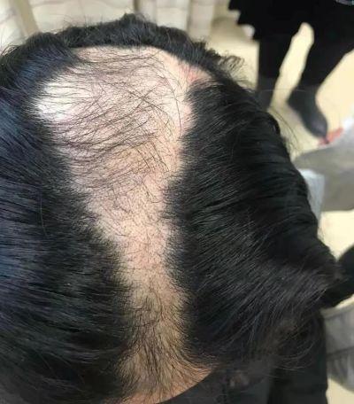 冲动性|“10后”也秃了？台州两个小学生不断脱发，查了半天，真相是这个