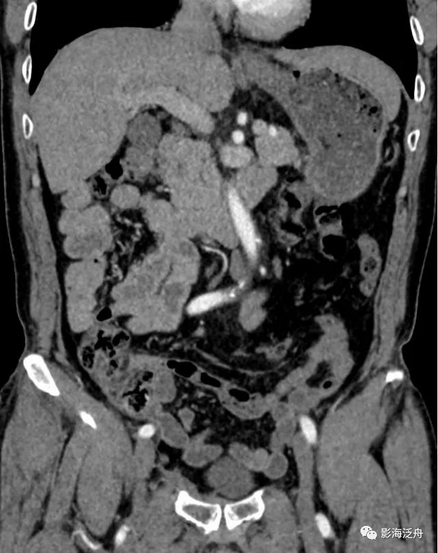 这个病，腹部CT经常会漏诊