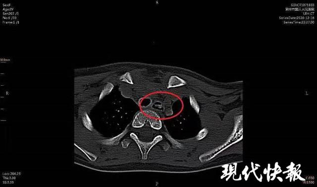 3岁女童食道被卡，取出一看是个“皮卡丘”