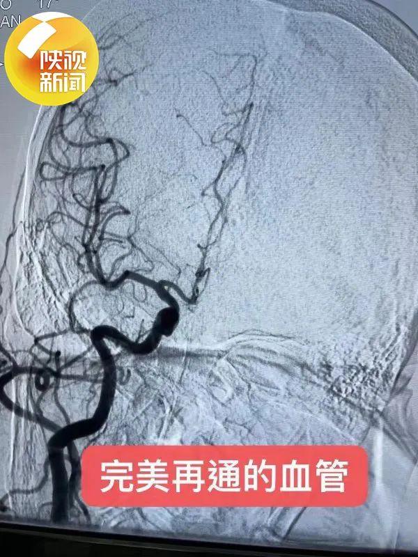 90岁老奶奶急性脑梗死 医生高超技术抽走致命血栓