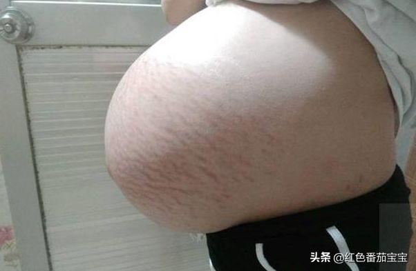#超级宝妈#孕妈“悬垂肚”，网友以为是“双胞胎”，不是好现象