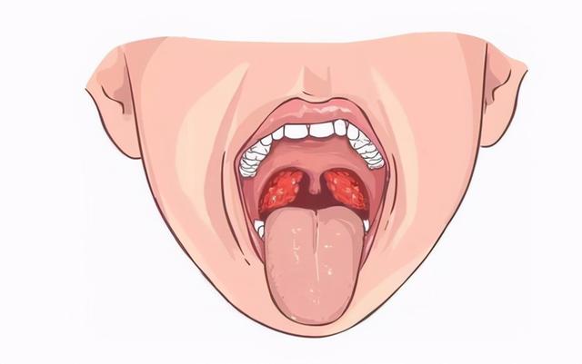 小孩子一年会患好几次的扁桃体炎，这些典型症状建议家长牢记