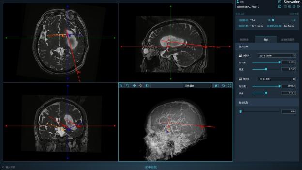 侯立军|高血压患者脑出血后失语又偏瘫 侯立军教授团队机器人手术妙手回春