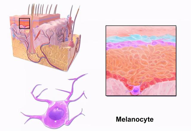 致命皮肤癌，未必由痣来！黑色素瘤是如何“凭空冒出”的？