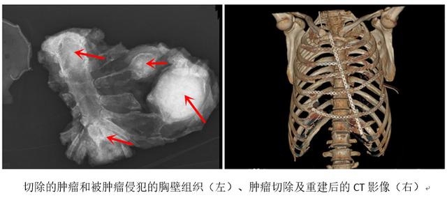 患者|65岁患者大范围胸壁肿瘤切除，篮球大小的缺损胸壁实现重建