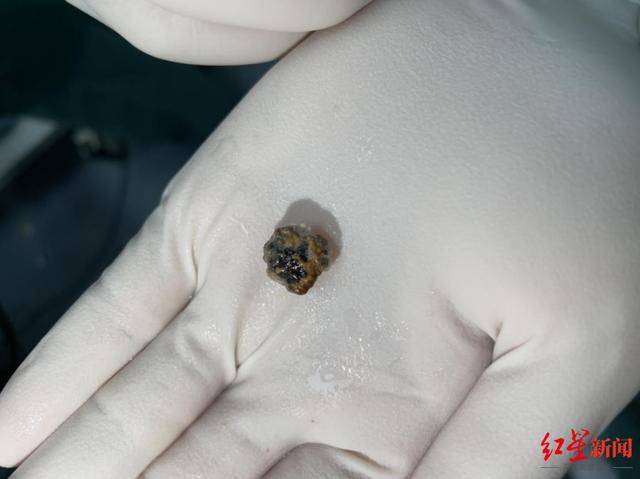 异物|男子近几年肺部反复感染入院，原因竟是“藏身”肺叶10年的一块鸡骨头