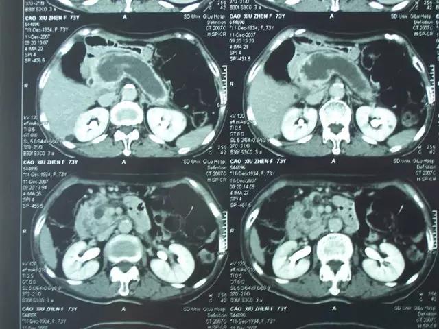 胰腺占位 CT 片不会看？这里一文教你掌握