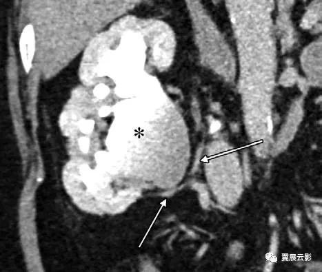 24张图汇总「肾血管」常见病变的影像学表现